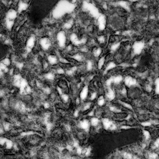 透射電鏡：內質網腫脹